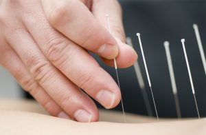 Close up shot of acupuncture needles