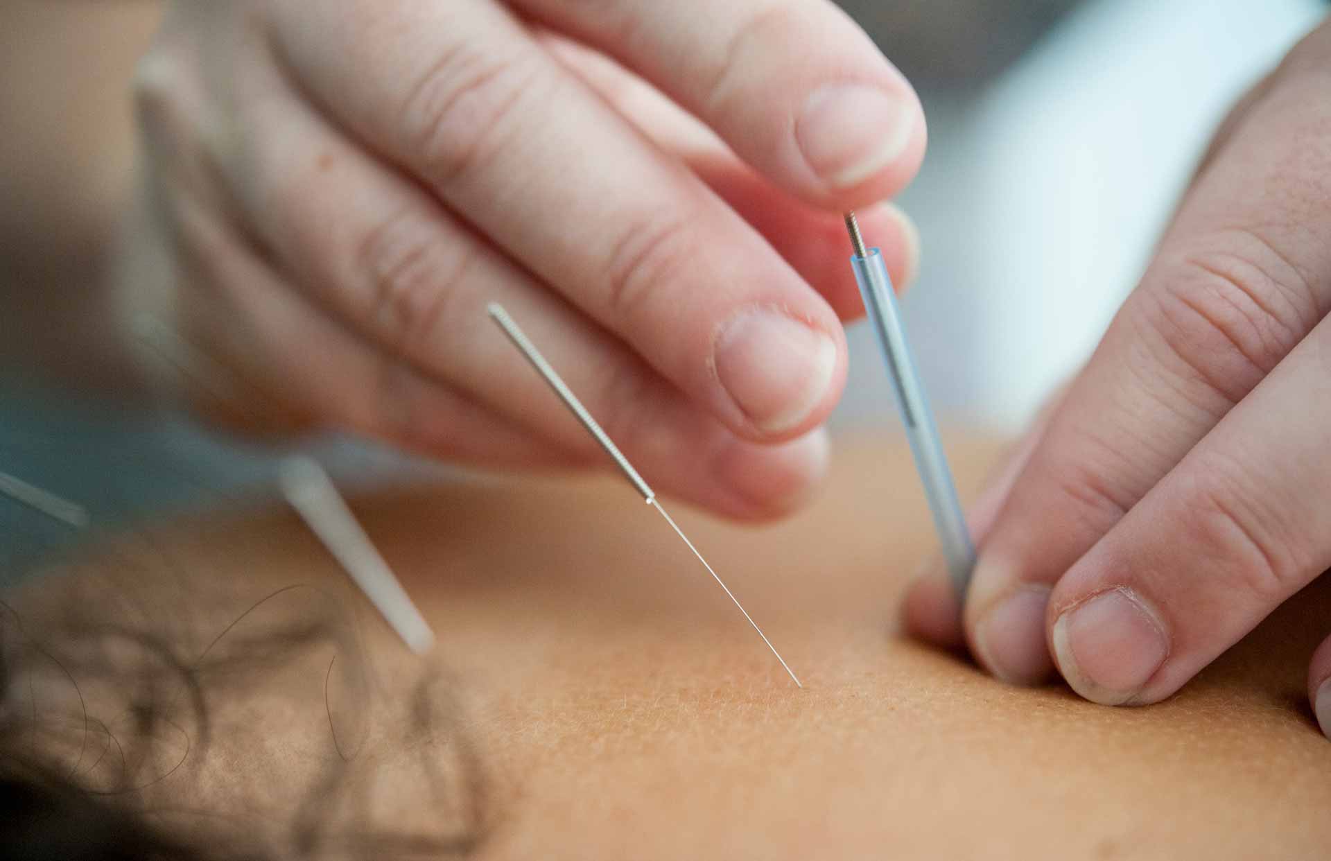 Close-up on acupuncture needles inserted in to back